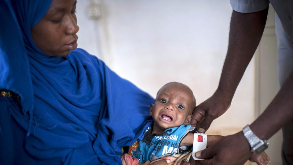 Zakaria Abdulkadir Mohamed ( 1 år) er en av de mange som kommer hver dag totalt utmagret og underernært til mor og barn-klinikken Jowle i Garowe, Somalia.